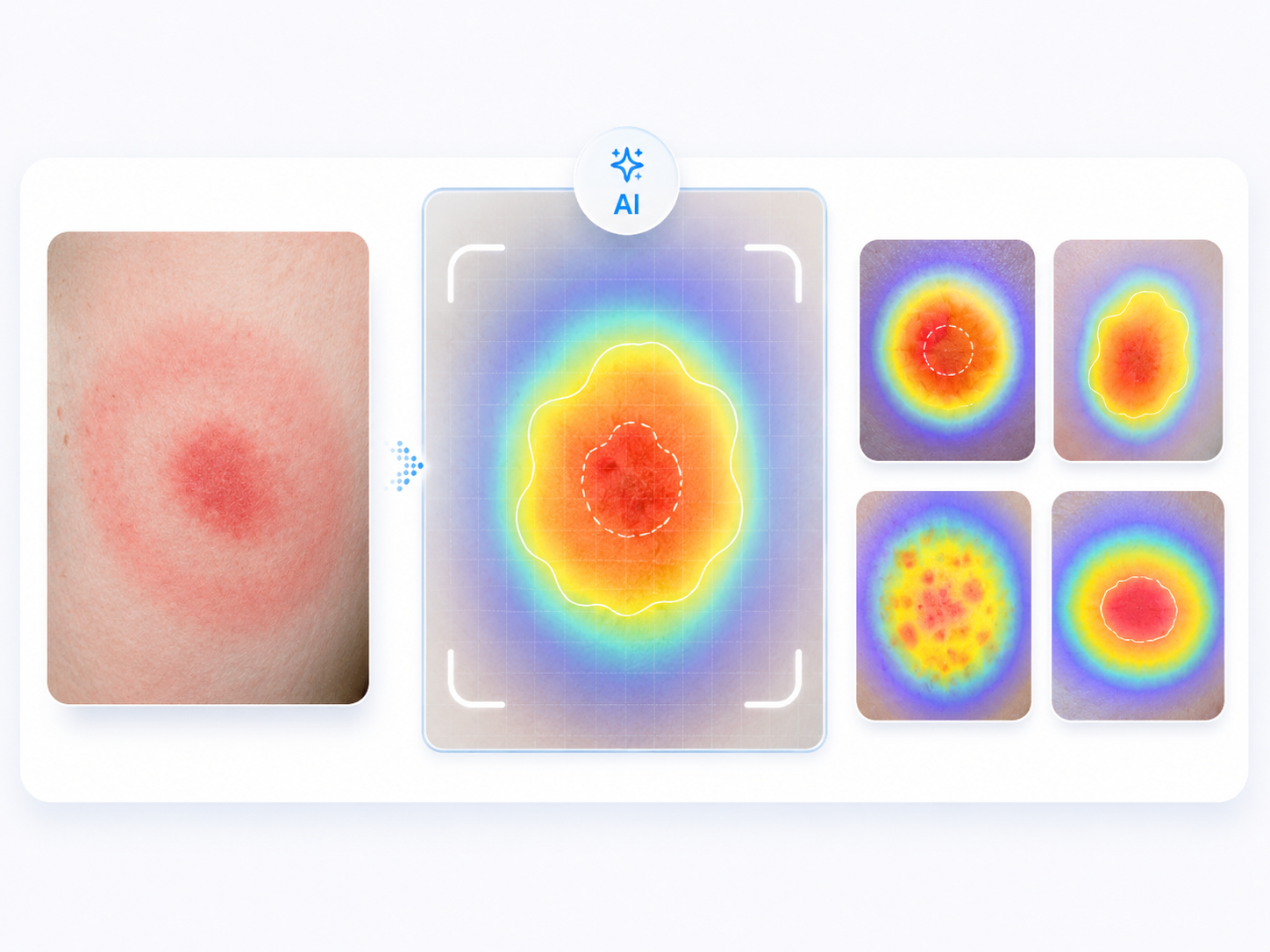 Vision AI rash pattern analysis